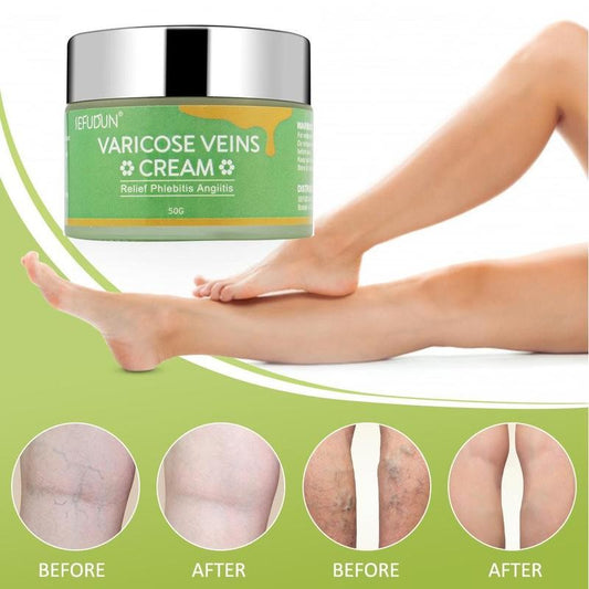 Crema para venas Varices// Vein Cream Red Blood Streaks Repair Earthworm Leg Bruises Bulge Relief Pain Safflower Skin care lotion Varicose Cream